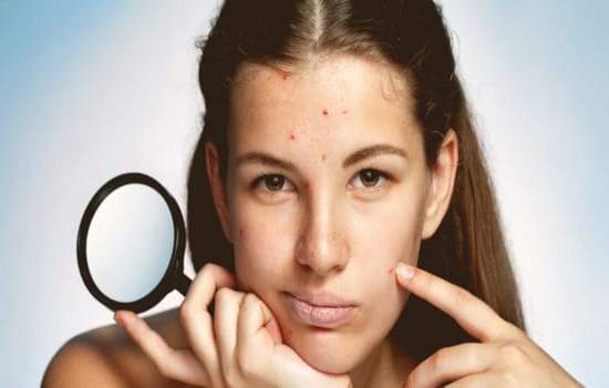 El acné en la adolescencia causas y tratamiento