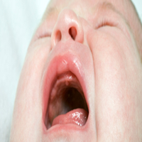 Llagas en la boca del Bebé