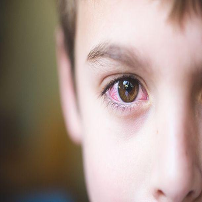 Conjuntivitis alérgica en los Niños