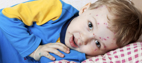 La varicela en los niños y su tramamiento