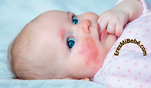 Remedios caseros para alergia en la piel del Bebe